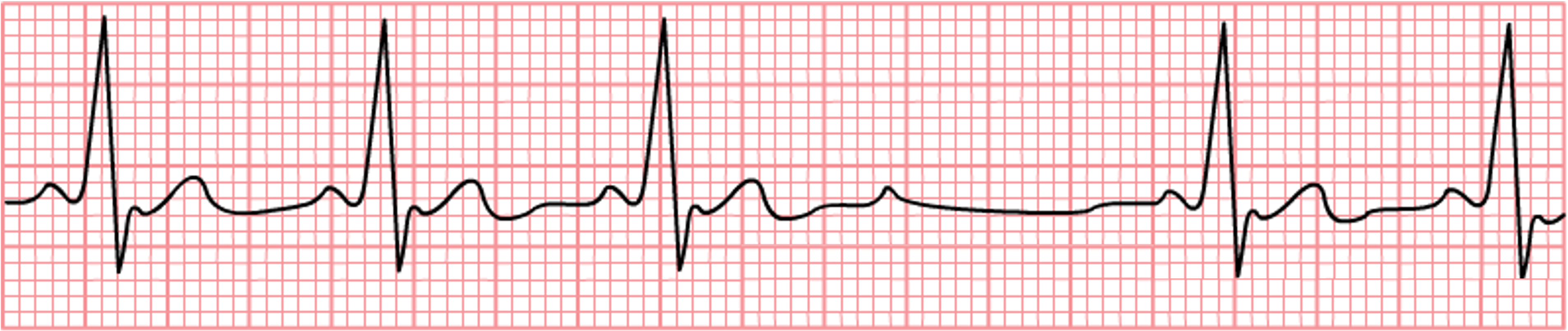 An EKG tracing illustrating 2nd-degree AV block type II (Mobitz II). Unlike Wenckebach, the PR interval does not progressively lengthen before the "dropped" beat.