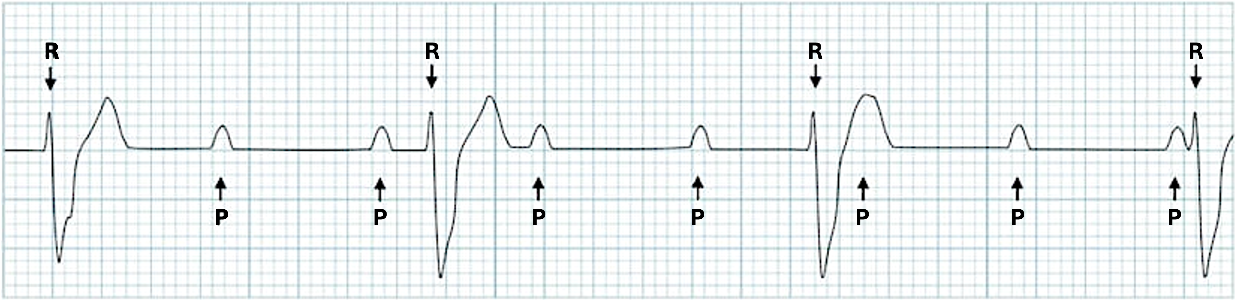 An EKG tracing illustrating 3rd-degree AV block, also known as complete heart block. The tracing shows P waves (labeled P) and QRS complexes (labeled R) occurring independently of each other, indicating a complete dissociation between atrial and ventricular activity.