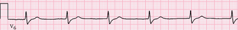 EKG rhythm depicting an accelerated idioventricular rhythm (AIVR), characterized by a regular rhythm with wide QRS complexes and a heart rate between 60–100 bpm.