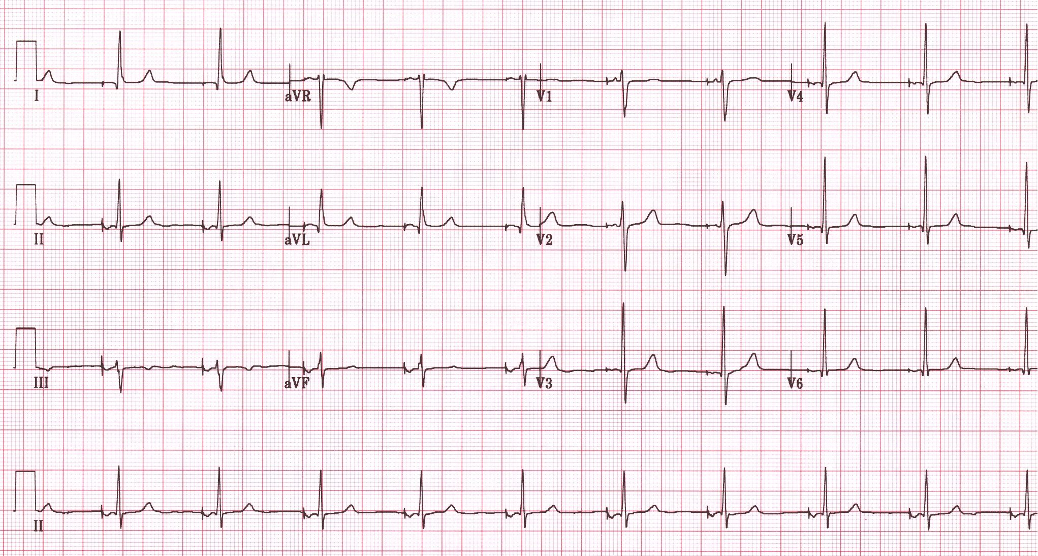 A 12-lead EKG showing atrial paced rhythm with narrow QRS complexes and consistent pacing spikes.