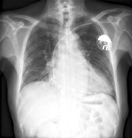 A chest X-ray showing a pacemaker implanted in the left upper chest area with leads extending into the heart.