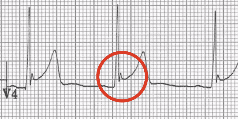 An EKG strip focusing on lead V4. The image highlights a "fish-hook" pattern in the ST segment, indicative of benign early repolarization.