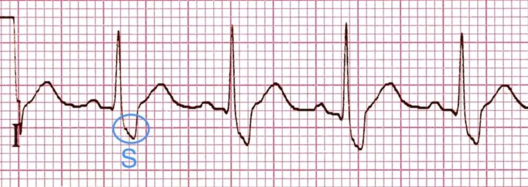 EKG rhythm strip showing a wide S wave in lead I indicative of right bundle branch block.