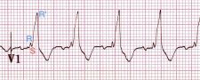 Bundle Branch Blocks and Hemiblocks – EKG Essentials: A Student Handbook