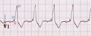 Bundle Branch Blocks and Hemiblocks – EKG Essentials: A Student Handbook