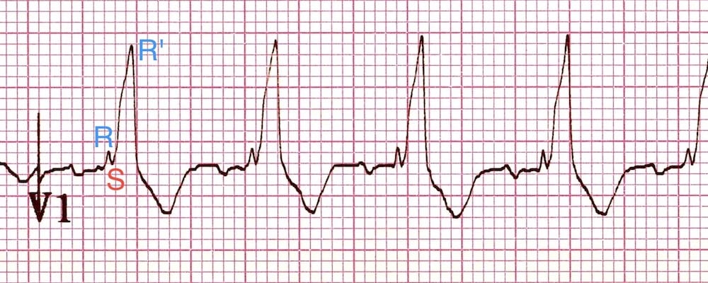 EKG rhythm strip showing an RSR' complex in lead V1 indicative of right bundle branch block.