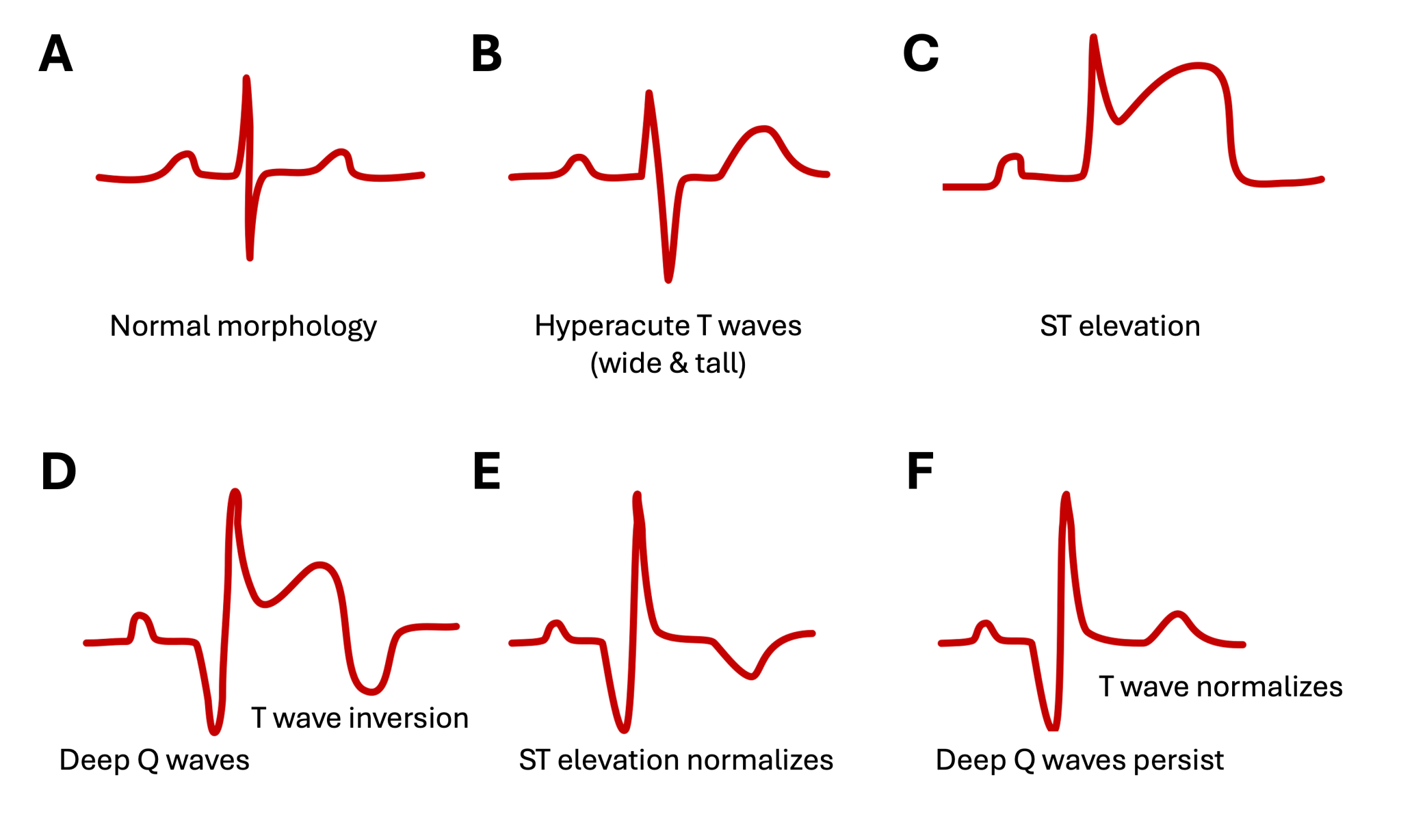 Myocardial Ischemia and Infarction – EKG Essentials: A Student Handbook