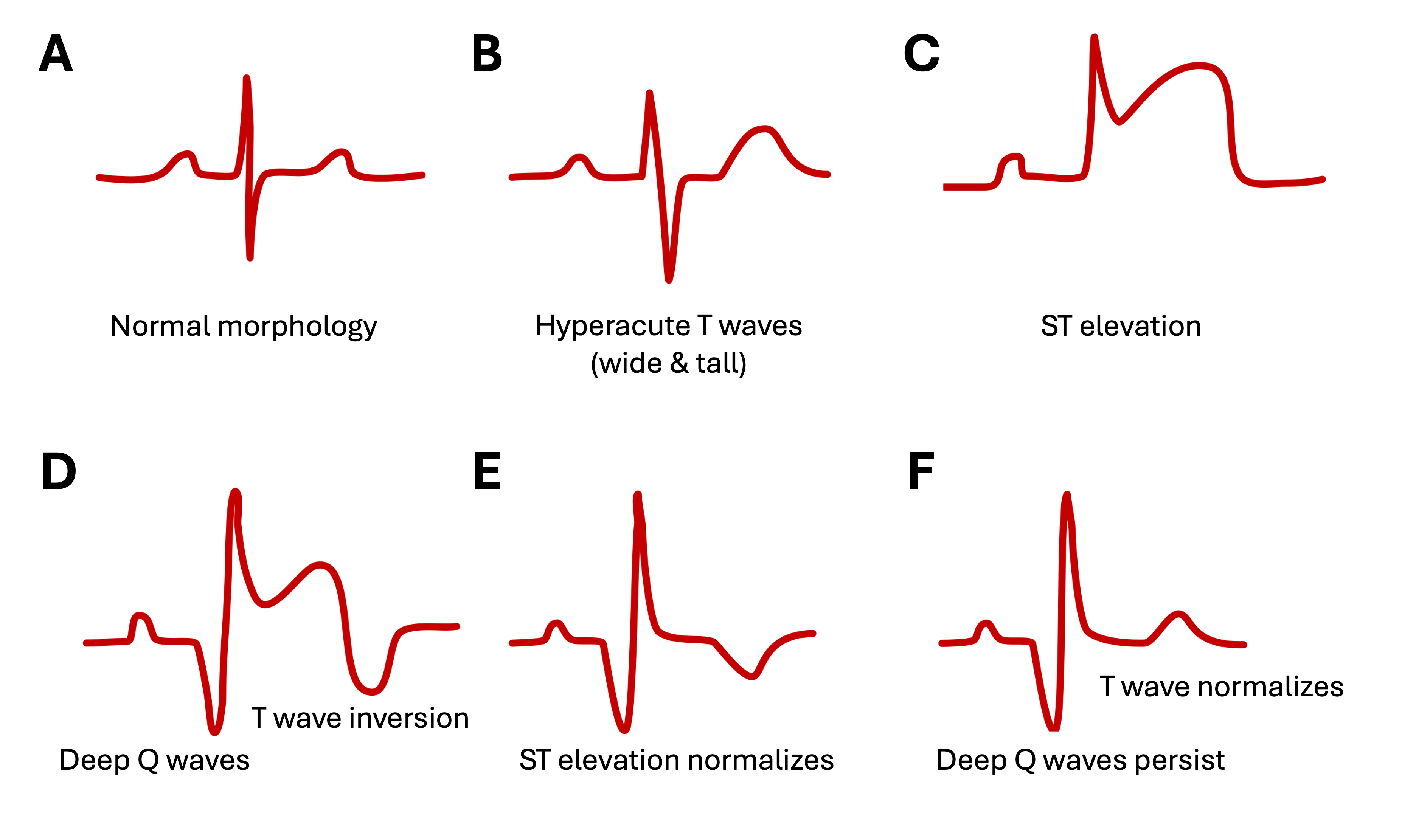 A diagram showing the evolution of myocardial infarction as signs on an EKG, starting with hyperacute T waves, followed by ST segment elevation, then the development of pathological Q waves and T wave inversion, and ending with deep Q waves that remain permanent on future EKG tracings for the patient.