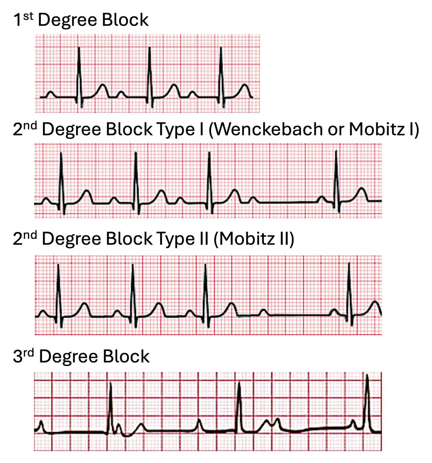 Atrioventricular Blocks – EKG Essentials: A Student Handbook