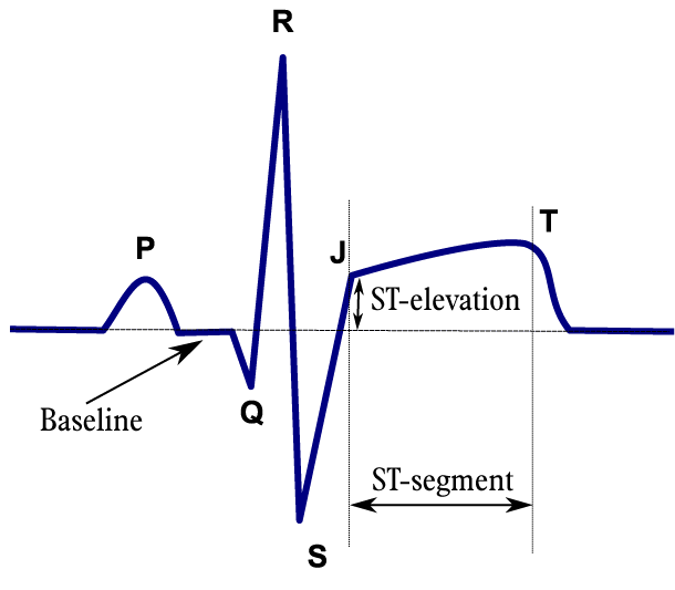 Diagram showing the measurement of ST segment elevation on an EKG, highlighting the distance from the baseline to the start of the upward curve of the ST segment.