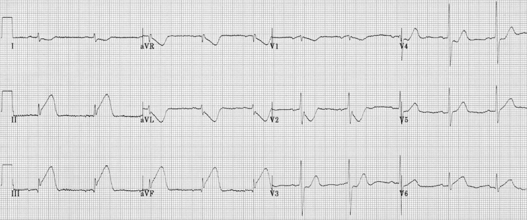 A 12-lead EKG showing an acute inferior myocardial infarction with ST segment elevation in leads II, III, and aVF, along with reciprocal ST segment depression in leads I and aVL, indicative of an inferior STEMI.