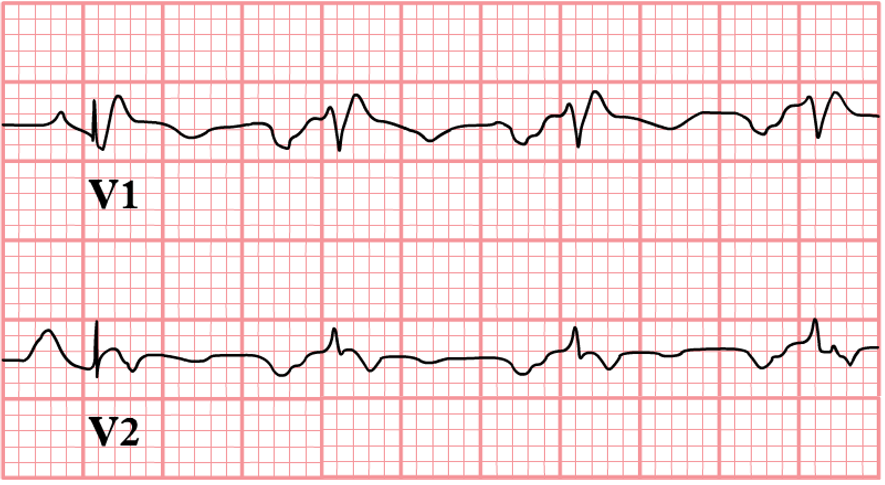 An EKG tracing in leads V1 and V2 illustrating left atrial enlargement (LAE) with biphasic P waves and a significant negative component in lead V1, indicative of an enlarged left atrium. Lead V2 also shows changes consistent with LAE.