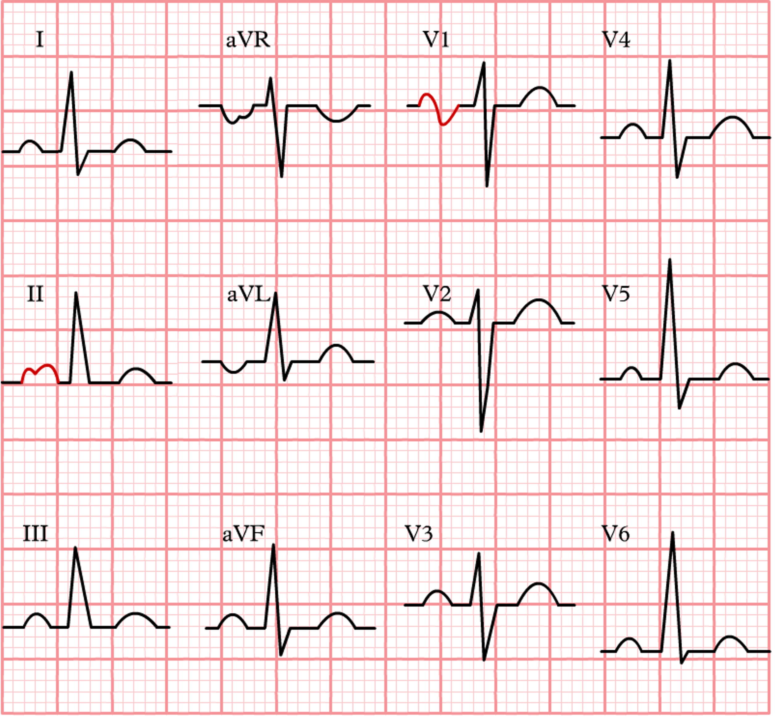 An EKG tracing illustrating left atrial enlargement (LAE) with a notched P wave in lead II and a biphasic P wave in lead V1. The EKG highlights these characteristics patterns indicating an increased size of the left atrium.