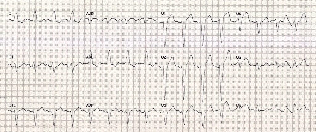 12-lead EKG showing left bundle branch block (LBBB) across multiple leads, with widened QRS complexes and distinctive deep S waves.