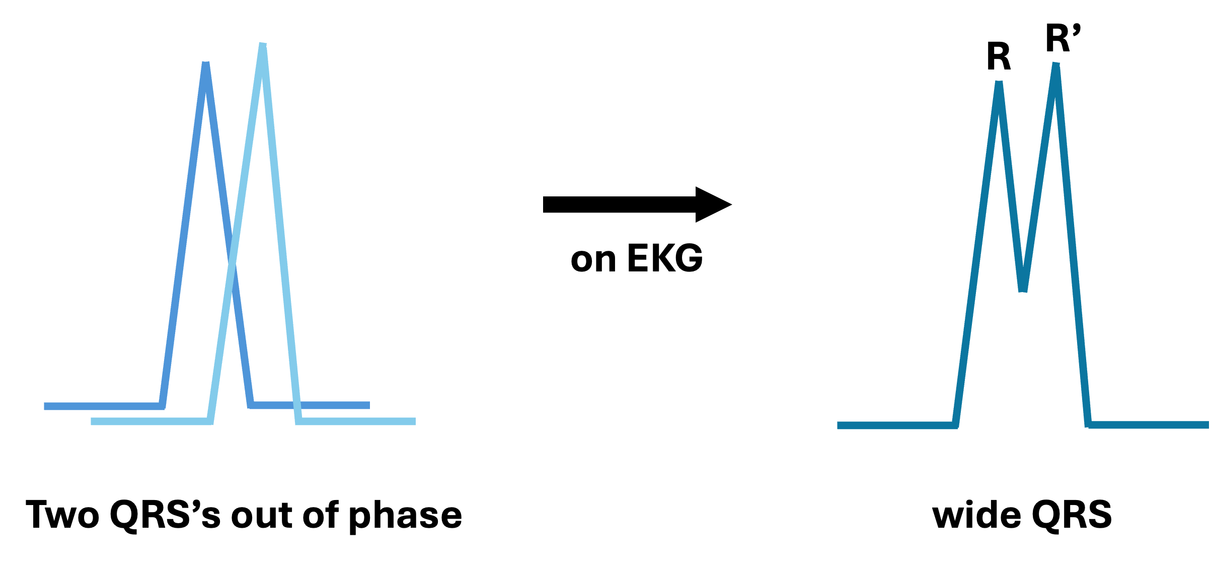 Diagram showing the notched or "M-shaped" characteristics in QRS complexes for left bundle branch in lead V1 and V6. In lead V1, the complex is characterized by a deep S wave, while in lead V6, it shows a broad, notched R wave.