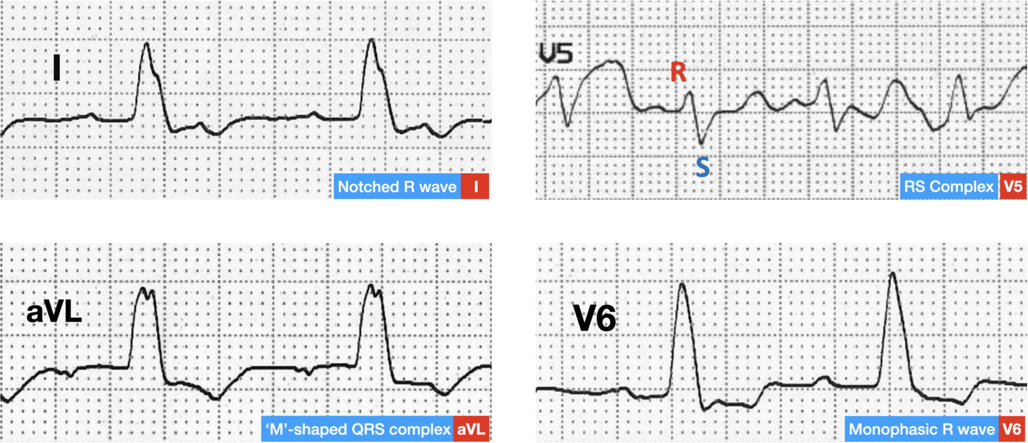 Bundle Branch Blocks and Hemiblocks – EKG Essentials: A Student Handbook