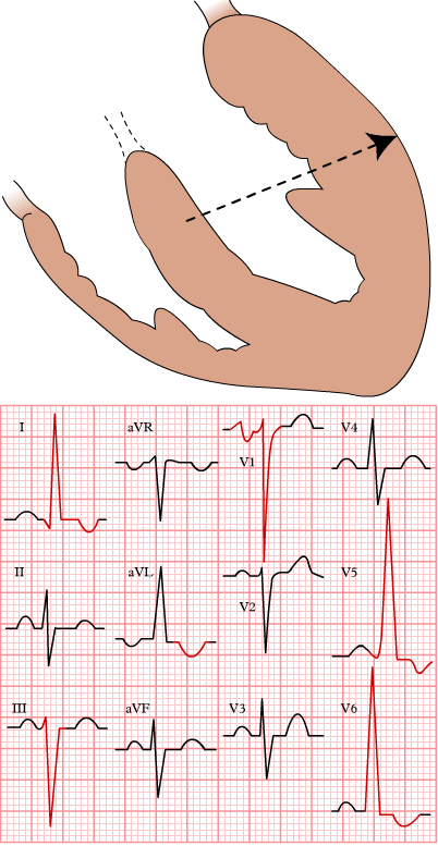 An illustration and EKG tracing demonstrating left ventricular hypertrophy (LVH). The top part shows the heart with thickened left ventricular walls, and the bottom part displays an EKG with tall R waves in leads V5 and V6, and deep S waves in leads V1 and V2, characteristic of LVH.