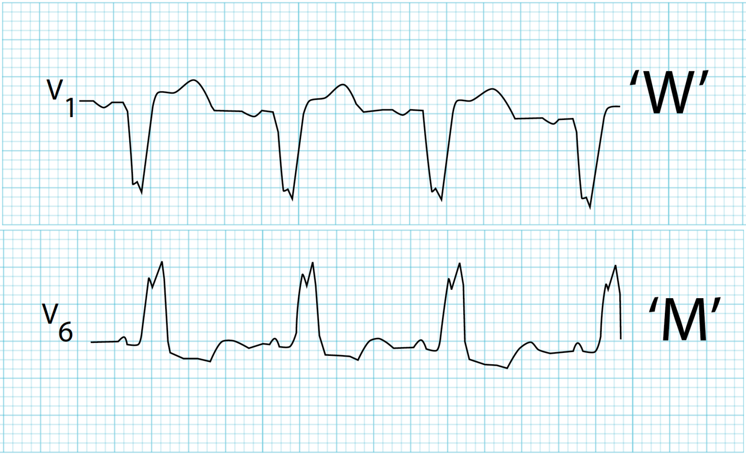 Bundle Branch Blocks and Hemiblocks – EKG Essentials: A Student Handbook