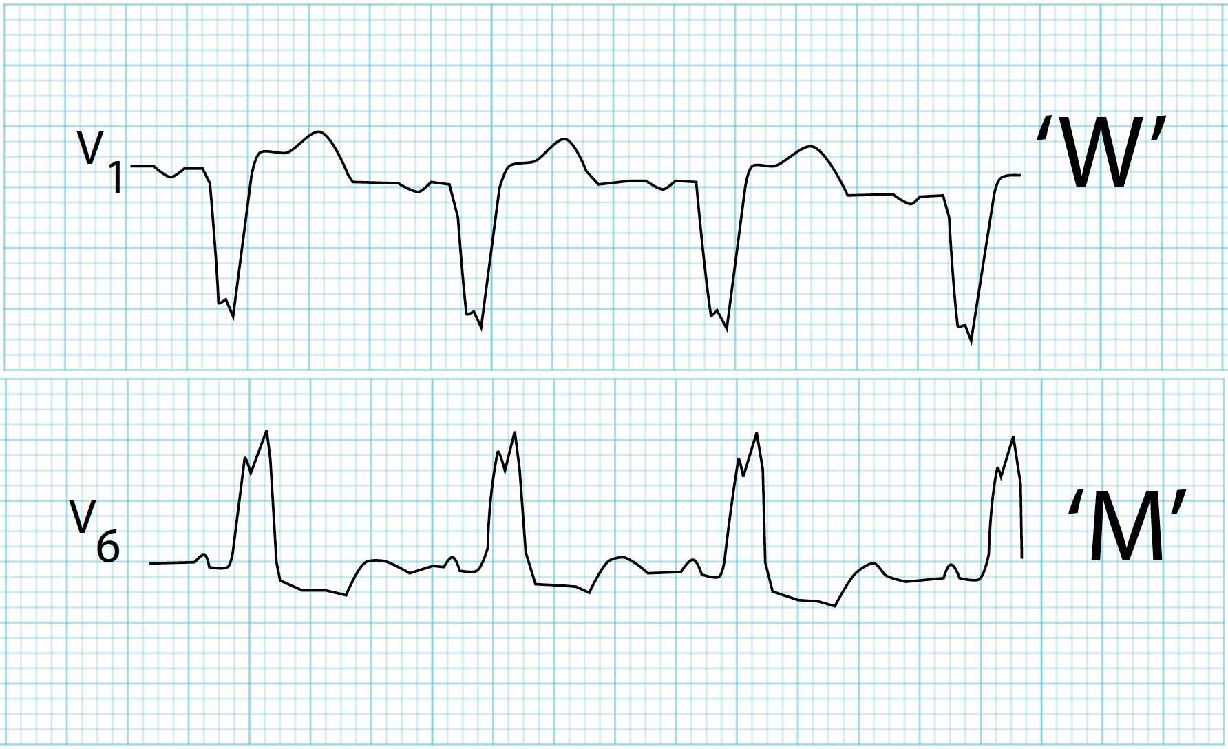 EKG strip displaying the characteristic "W" shape in lead V1 and "M" shape in lead V6, indicative of left bundle branch block (LBBB).