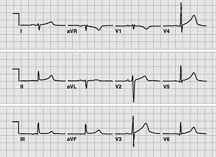 Bundle Branch Blocks and Hemiblocks – EKG Essentials: A Student Handbook