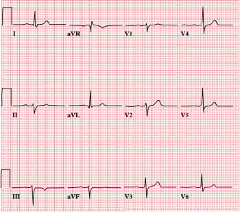 Bundle Branch Blocks and Hemiblocks – EKG Essentials: A Student Handbook