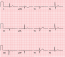 Bundle Branch Blocks and Hemiblocks – EKG Essentials: A Student Handbook