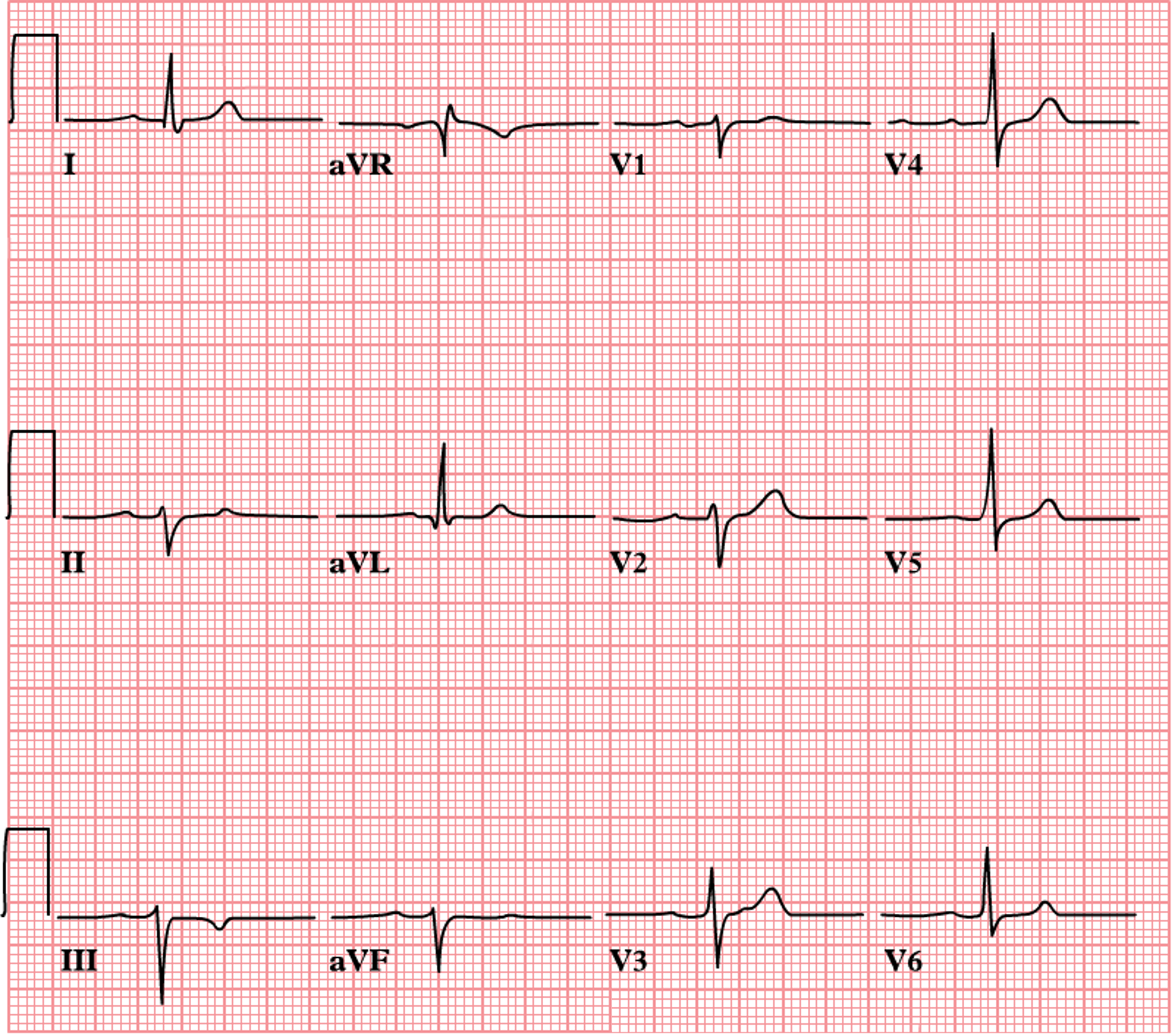 12-lead EKG displaying left anterior hemiblock (LAHB) with characteristic left axis deviation, small Q waves and tall R waves in leads I and aVL, as well as small R waves and deep S waves in leads II, III, and aVF.