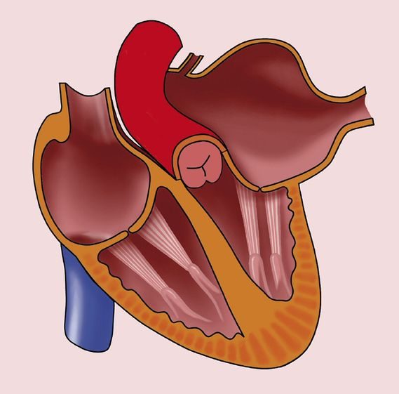 An anatomical illustration of the heart depicting left atrial enlargement. The image shows an enlarged left atrium, which can result from increased pressure or volume overload due to conditions like mitral valve disease, chronic hypertension, or heart failure. The illustration provides a clear visual representation of the structural changes associated with left atrial enlargement.