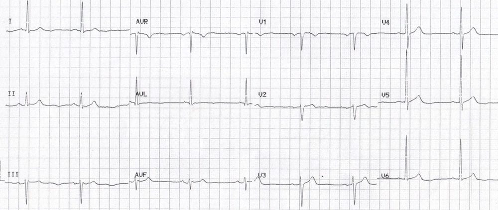 A 12-lead EKG showing non-ST elevation myocardial infarction (NSTEMI) with characteristic inverted U waves, particularly noticeable in the lateral leads (V4–V6) and possibly also in leads II and III.