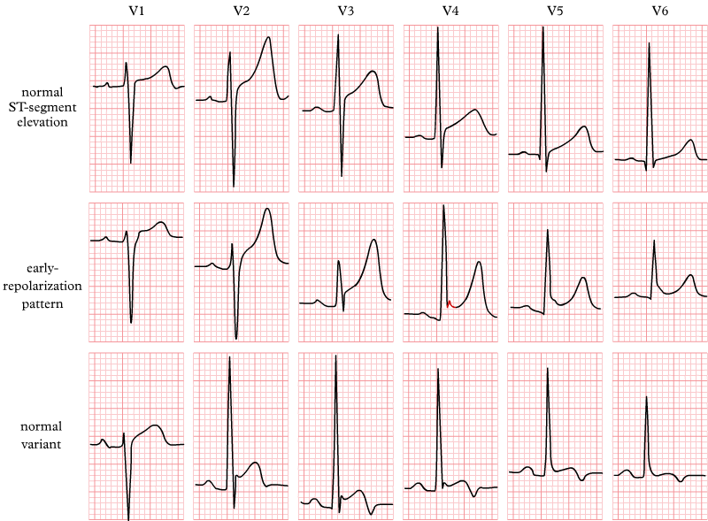 An EKG chart showing various patterns of normal, non-pathological ST segment elevation in precordial leads V1–V6, including normal elevation, early repolarization patterns, and other normal variants.