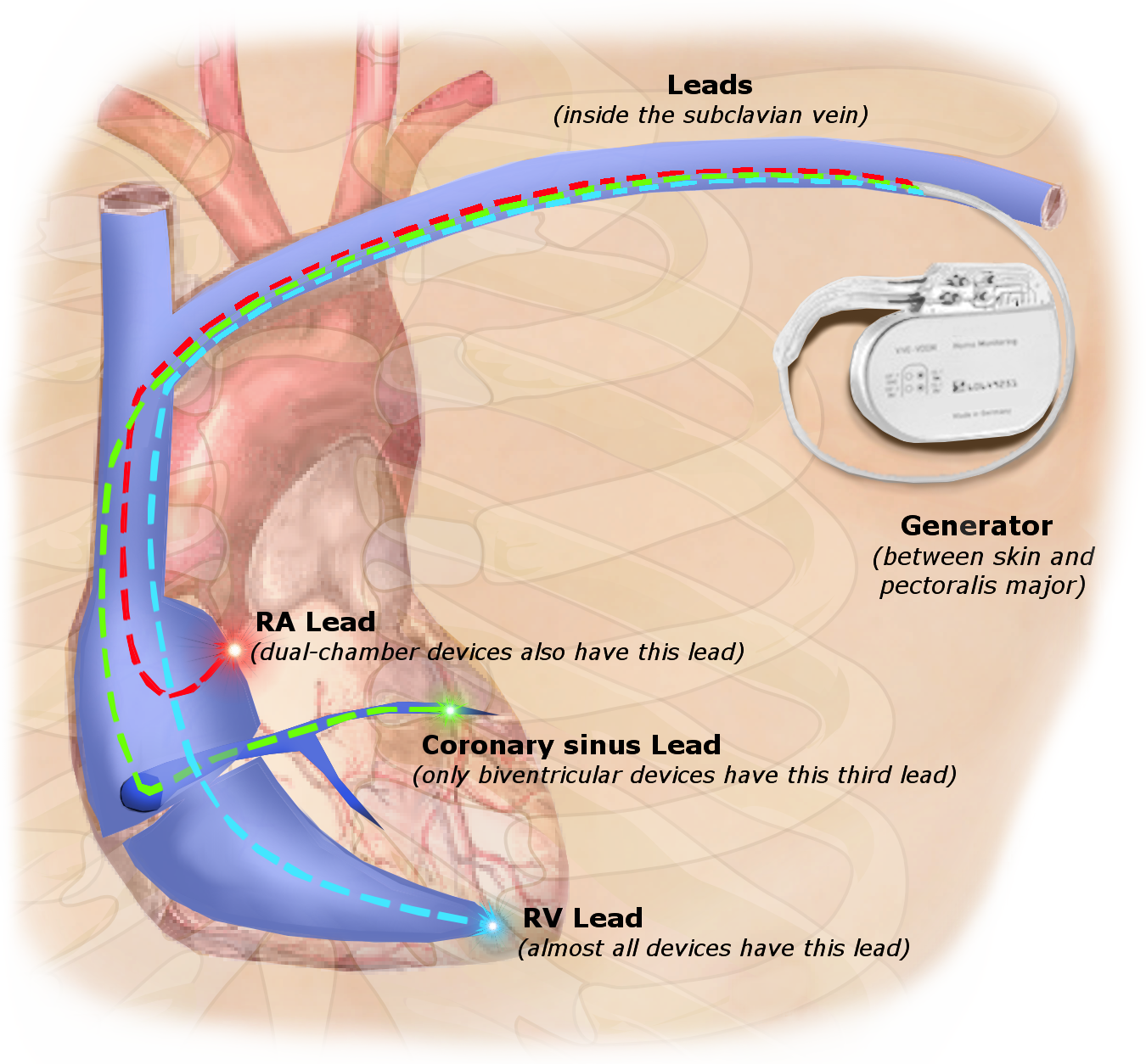 A medical diagram illustrating the placement of a pacemaker and its leads within the heart, showing the routes and locations of the right atrium lead, right ventricle lead, and coronary sinus lead, along with the generator placed between the skin and pectoralis major.