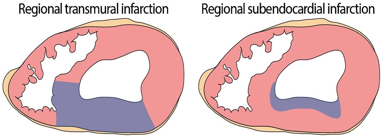 Two diagrams showing different patterns of myocardial infarction in cross-sections of the heart muscle. Left diagram shows regional transmural infarction with damage spanning the entire thickness of the myocardium in a localized region. The right diagram depicts regional subendocardial infarction with damage limited to the inner layer of the myocardium in a specific area.