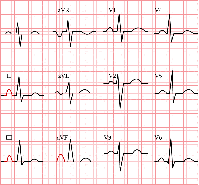 An EKG tracing illustrating right atrial enlargement (RAE) with tall, peaked P waves in leads II, III, and aVF. The EKG highlights these characteristic patterns indicative of an increased right atrial size.