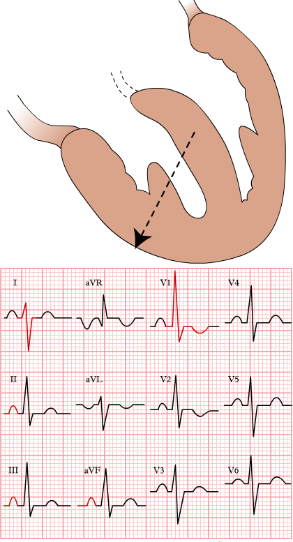 An illustration and EKG demonstrating right ventricular hypertrophy (RVH). The top part shows the heart with thickened right ventricular walls, and the bottom part displays an EKG with right axis deviation, tall R waves in V1 and V2, and deep S waves in V5 and V6, characteristic EKG changes associated with RVH.