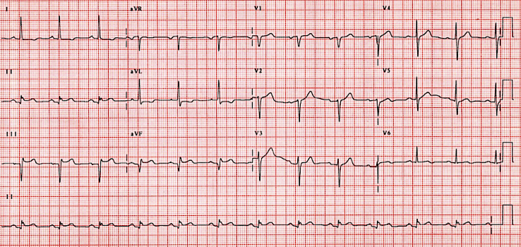 A 12-lead EKG showing a recent inferior myocardial infarction with ST elevation in leads II, III, and aVF, pathological Q waves in leads III and aVF, inverted T waves in leads I and aVL, as well as reciprocal ST depression in lateral leads I, aVL, V5, and V6.