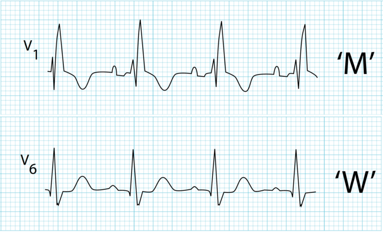 EKG strips showing right bundle branch block (RBBB) with a "M-shaped" QRS pattern in lead V1 and a "W-shaped" QRS pattern in lead V6.