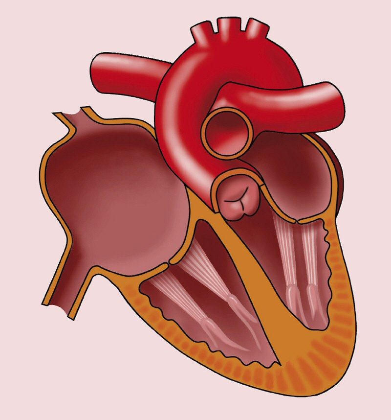 An anatomical illustration of the heart depicting right atrial enlargement. The image shows an enlarged right atrium, which can result from increased pressure or volume overload due to conditions like chronic lung disease or pulmonary hypertension. The illustration provides a clear visual representation of the structural changes associated with right atrial enlargement.