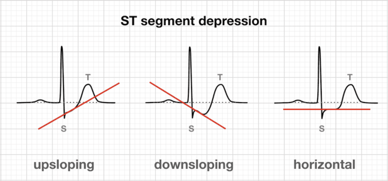 Three diagrams illustrating different types of ST segment depression. The first diagram shows upsloping ST depression, the second shows downsloping ST depression, and the third shows horizontal ST depression.