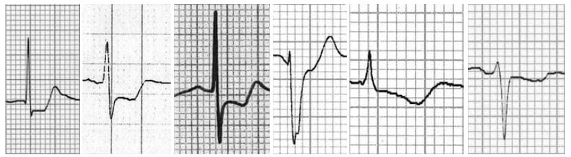 Six QRS complexes from different EKG strips showing different morphologies of ST depression associated with myocardial ischemia. The morphologies vary in shape, amplitude, and duration of the ST segment depression.