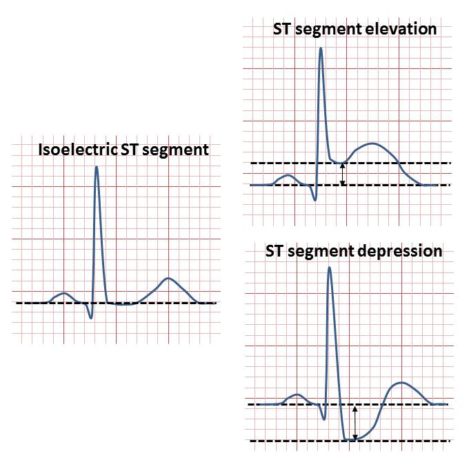 Myocardial Ischemia and Infarction – EKG Essentials: A Student Handbook