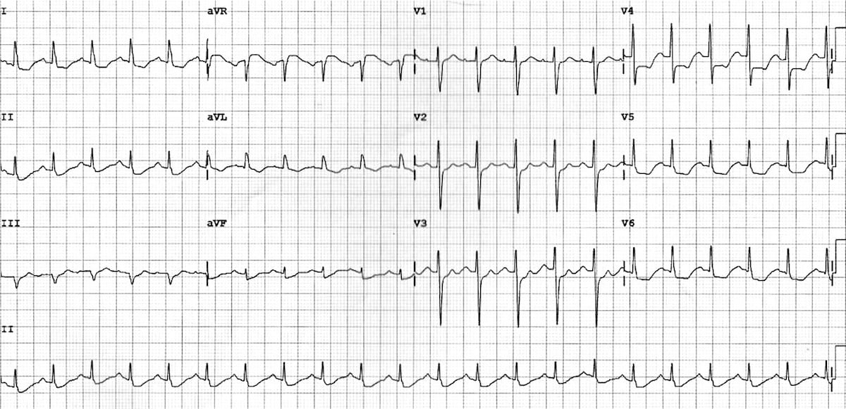 A 12-lead EKG displaying signs consistent with subendocardial ischemia. Each lead (I, II, III, aVL, AVF, V1–V6), except aVR, shows characteristic changes, including ST segment depression and T wave inversion, indicating reduced blood flow in the subendocardial region of the heart. ST segment elevation is demonstrated in lead aVR, another characteristic EKG change of subendocardial ischemia.