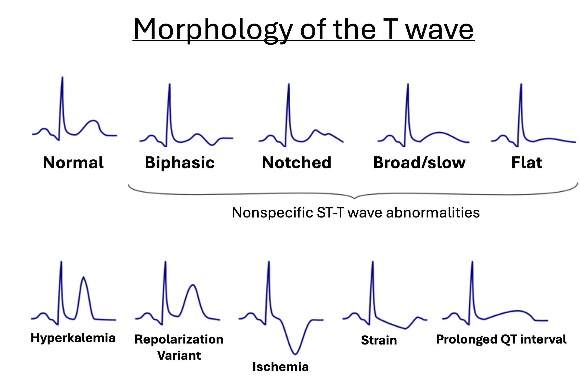 Names and examples of various T wave changes that occur on the EKG