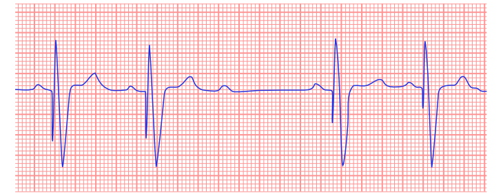 Rhythm strip showing a ventricular sensing malfunction, characterized by irregular pacing spikes due to oversensing of ventricular activity.