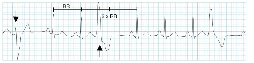 Rhythm strip depicting PVCs of different morphology