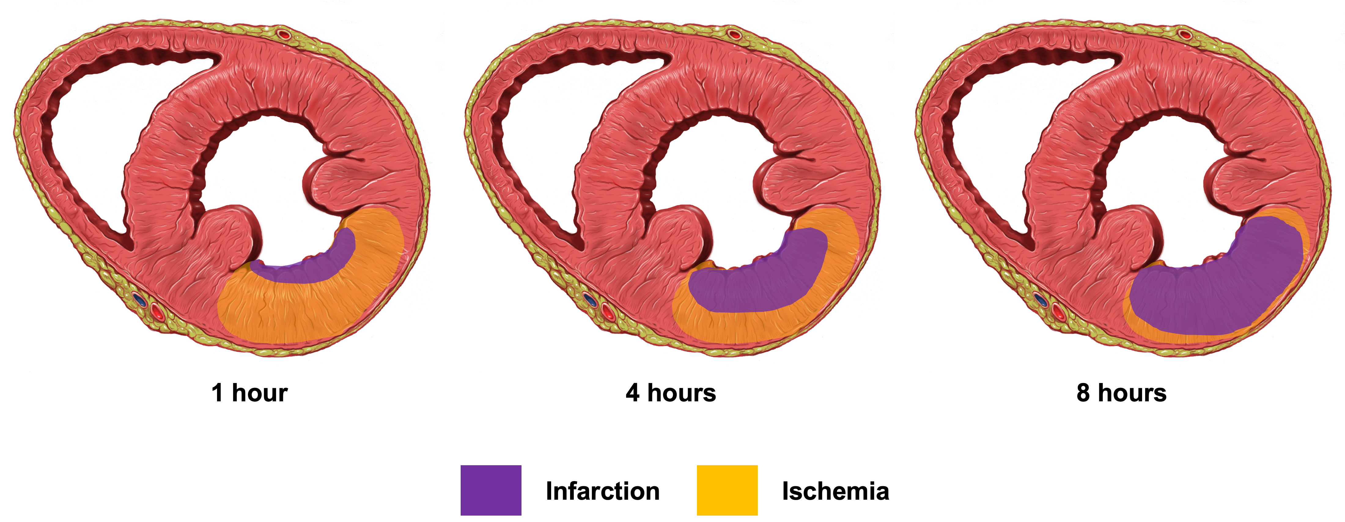 Series of three cross-sectional images of the heart showing progression of heart damage due to infarction. The first image shows a small, localized area of damage (colored in purple) within the heart muscle (left ventricle). The second image shows an increased area of damage (purple) surrounded by a zone of risk or ischemia (colored in orange). The third image depicts a large area of infarction (purple) extending through the heart muscle.