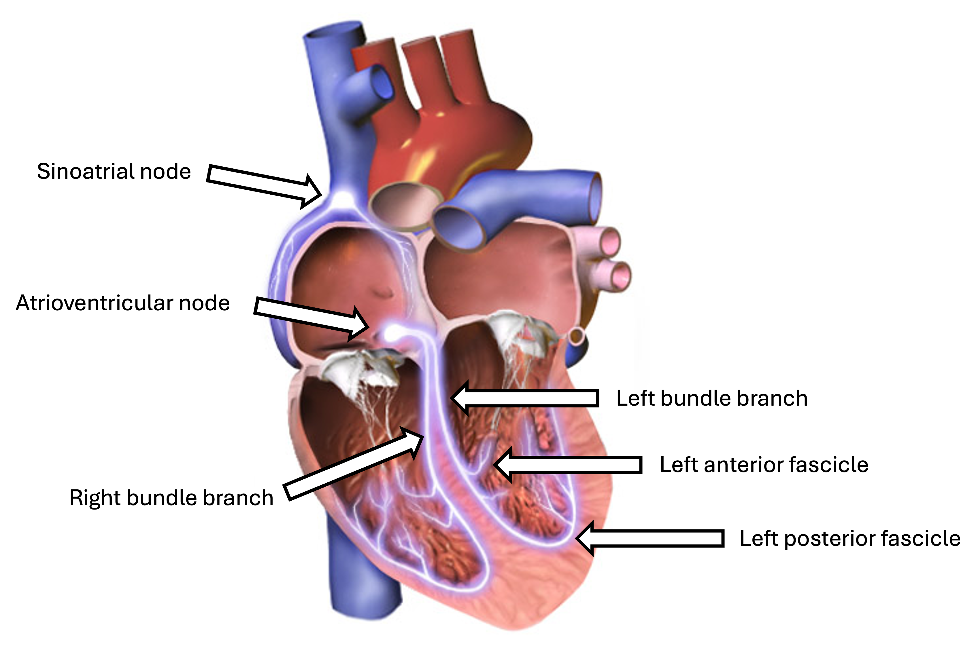 Anatomical illustration of the human heart with arrows pointing to certain portions of the cardiac electrical conduction system.