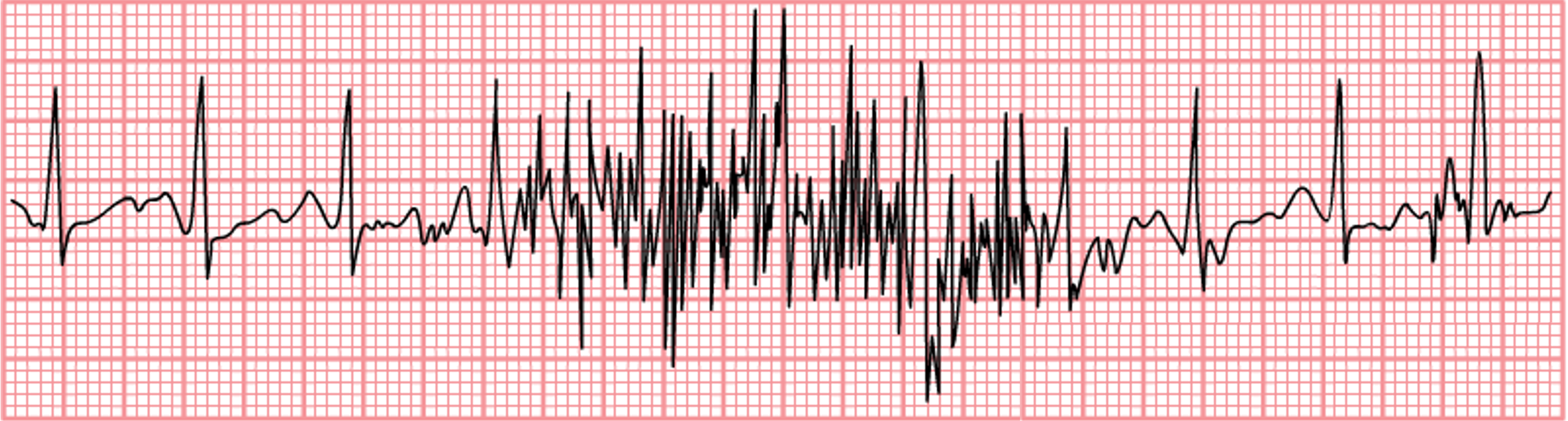 A rhythm strip showing the signal noise, or artifact, that occurs on the EKG tracing. In this case, from the patient moving.