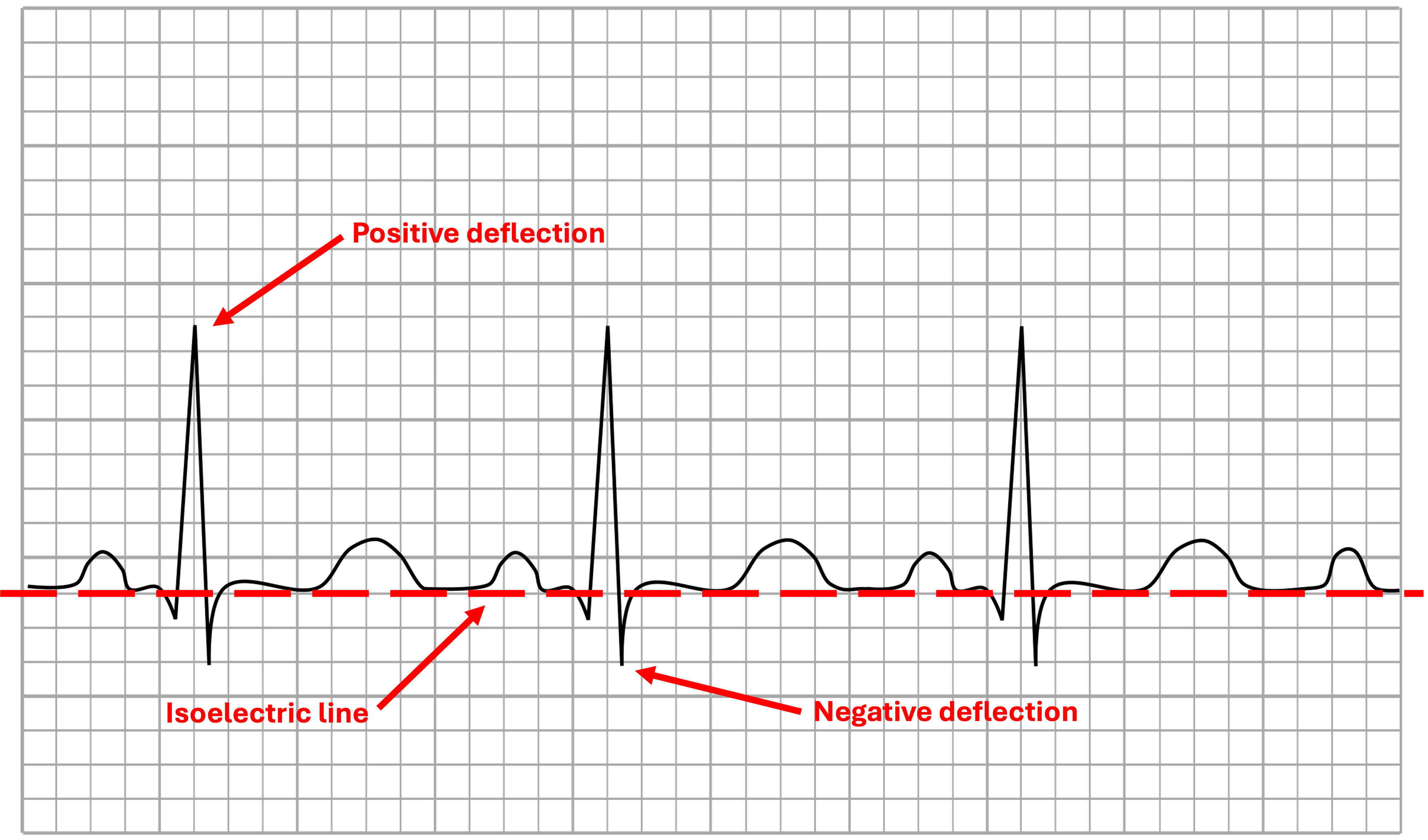 An EKG tracing showing labeled components such as the positive deflection, negative deflection, and isoelectric line. The trace highlights how the electrical activity of the heart is represented on an EKG, with upward and downward movements from the baseline (isoelectric line) corresponding to the positive and negative deflections, respectively.