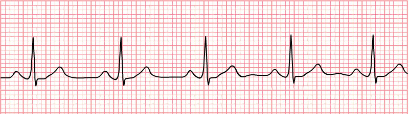 A rhythm strip showing normal sinus rhythm.