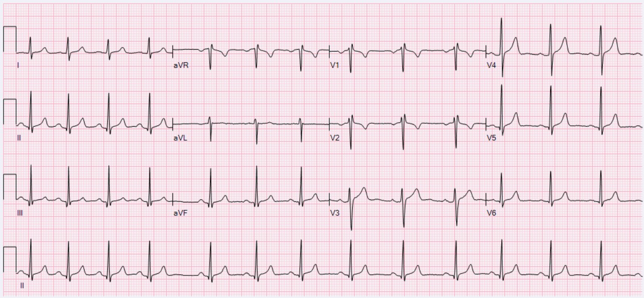 A 12-lead EKG tracing showing sinus arrhythmia with slightly irregular spacing between QRS complexes across all leads.